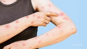 Confirmado em Foz do Iguaçu, o primeiro caso de Mpox no Paraná em 2026